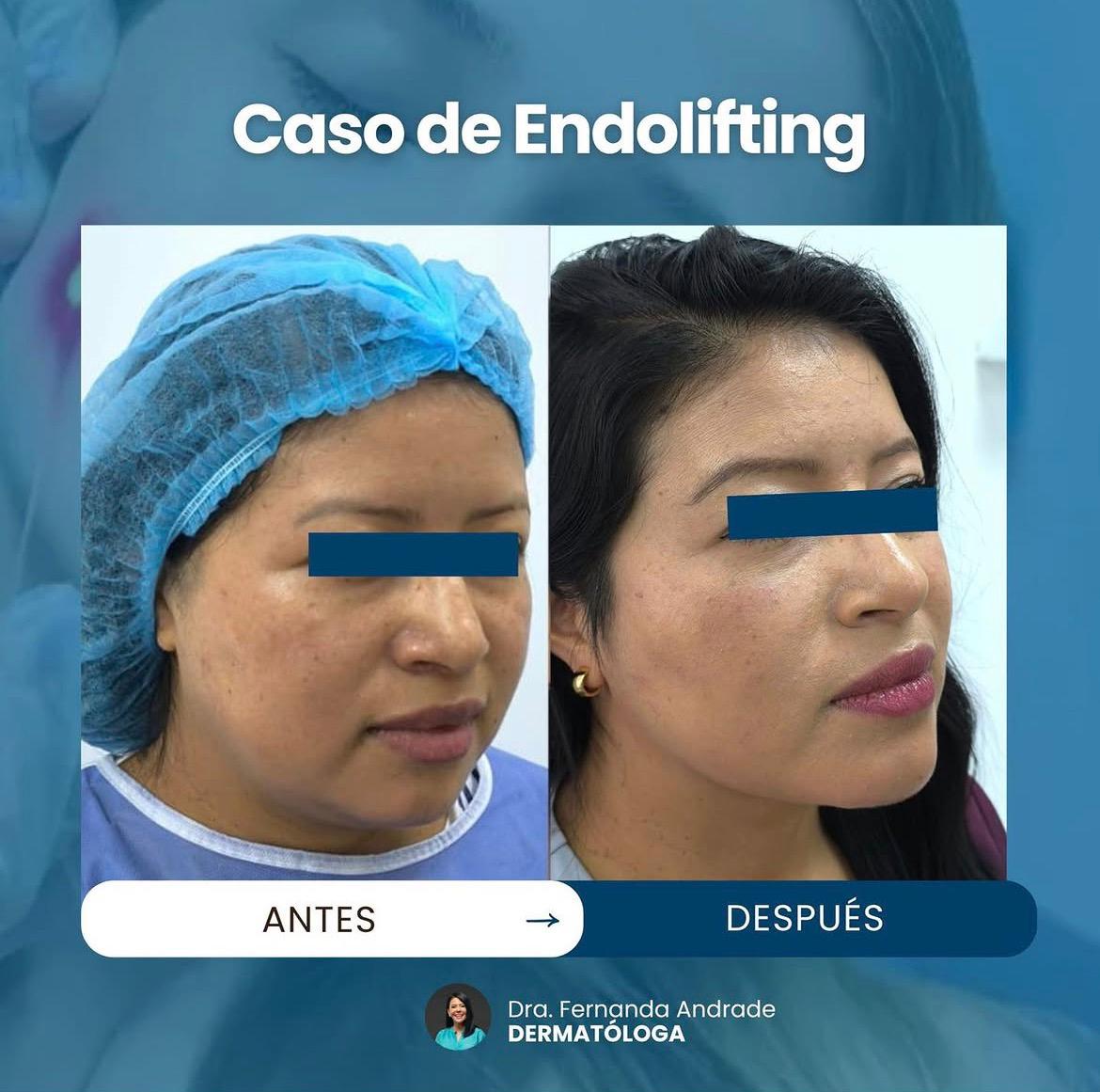 Caso de endolifting antes y después